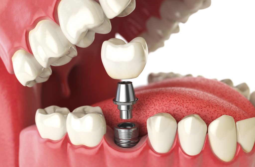 Rendering of crown on top of dental implant in side view of human mouth