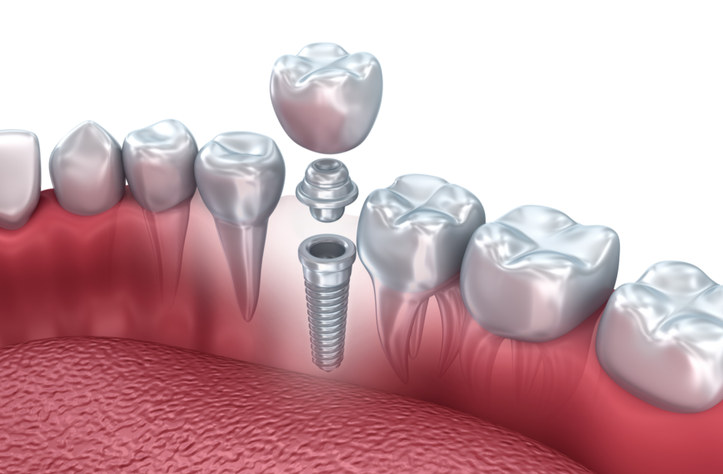 Rendering of dental implant including metal root, abutment, and artificial tooth