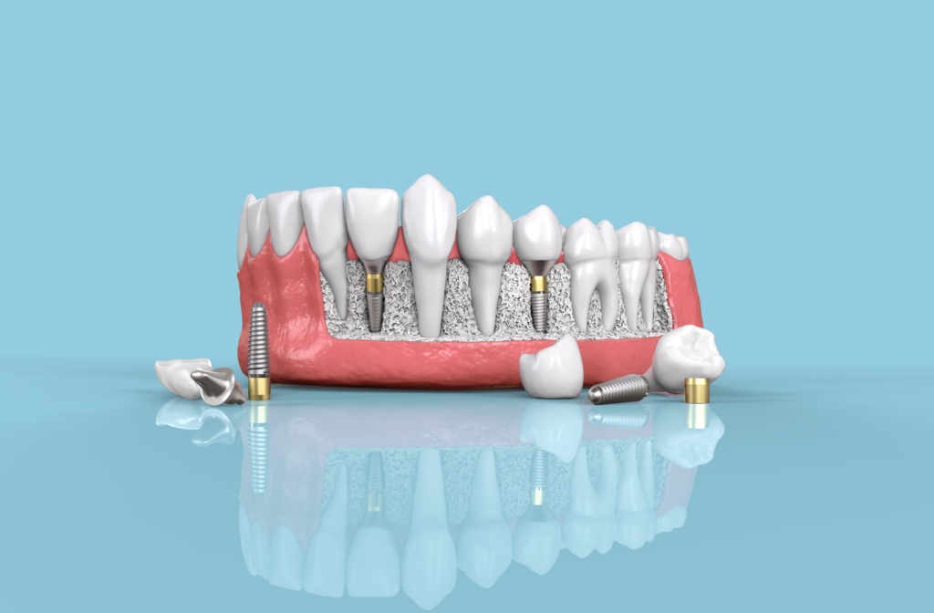 Rendering of lower jaw with several dental implants