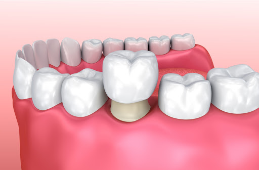 3D illustration of a dental crown installation