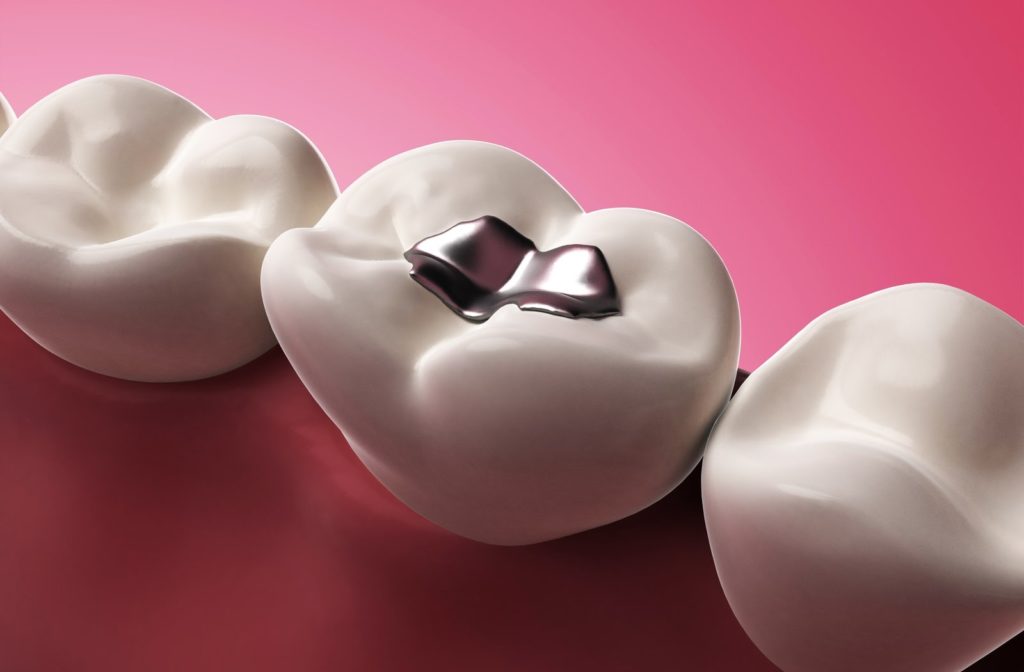 A 3 dimensional diagram of an amalgam dental filling