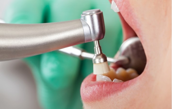 A patient's open mouth getting their teeth polished at the dentist to retain good oral hygiene