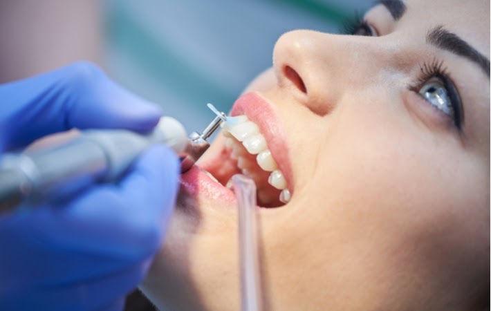 A close up of a woman at the dentist getting her teeth cleaned to prevent the development of tooth decay