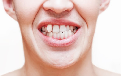 A person's mouth with crooked teeth, putting them at risk for gum disease