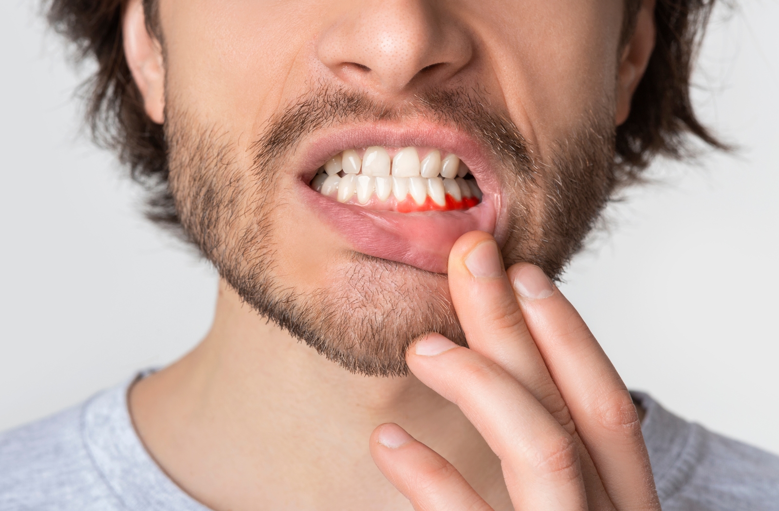 Man pulling back his lip to show the redness from his infected gum