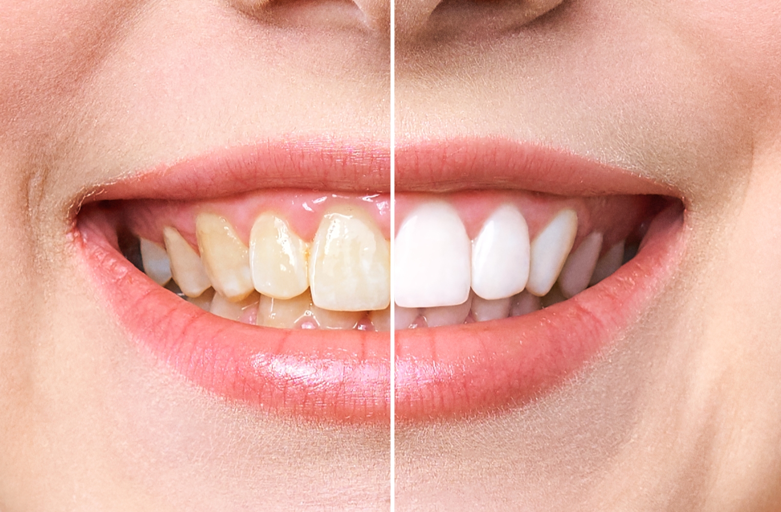 The before and after of a professional teeth whitening