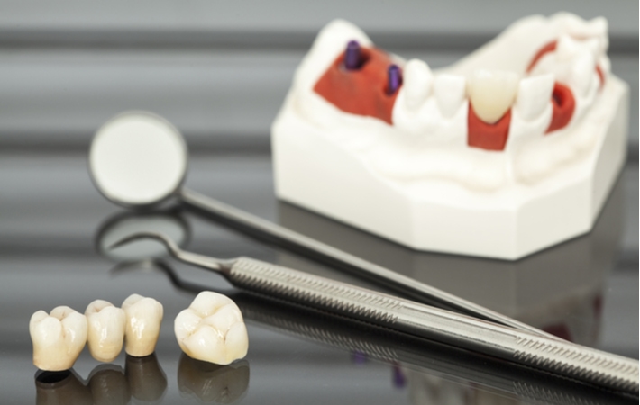 An dental bridge seated next to a dental crown with dental tools and a model of lower teeth blurred behind