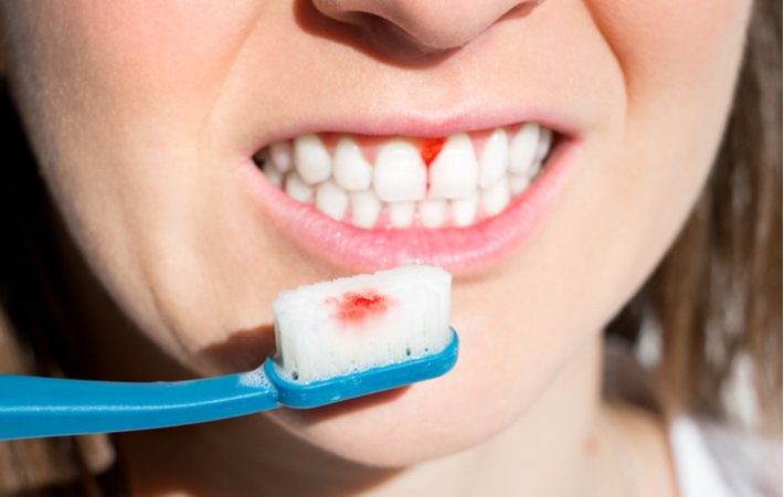 A woman showing her toothbrush after brushing with a small amount of blood on the bristles, due to her bleeding gums from gingivitis