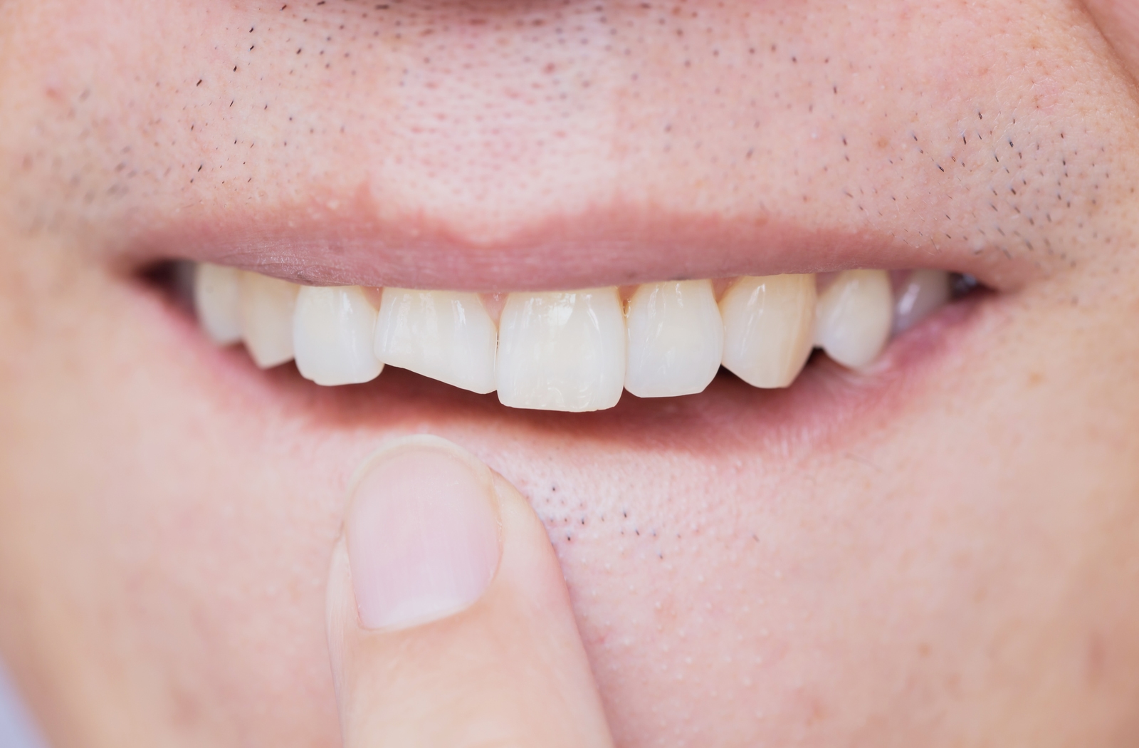 A close up of a person using their finger to point at one of their front teeth that have been broken