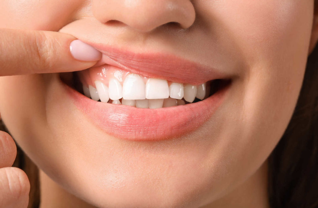 A close up of a woman smiling using her finger to lift up her lip to show off her teeth.