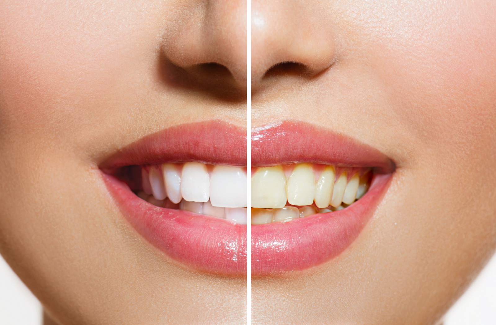 A divided perspective of a woman illustrating the contrast between her white and yellow teeth.