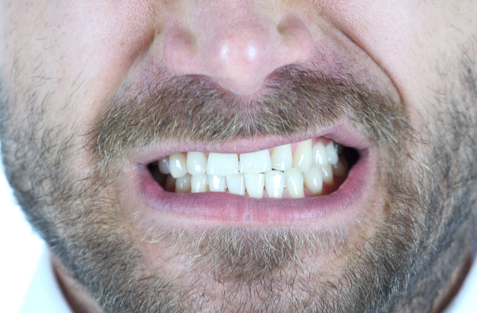 A close-up image of a bearded man tightly grinding his teeth.