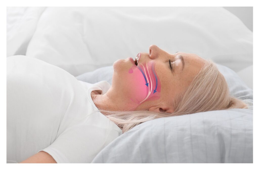 A person lays in bed with an illustration showing how the airway closes during obstructive sleep apnea on their face.