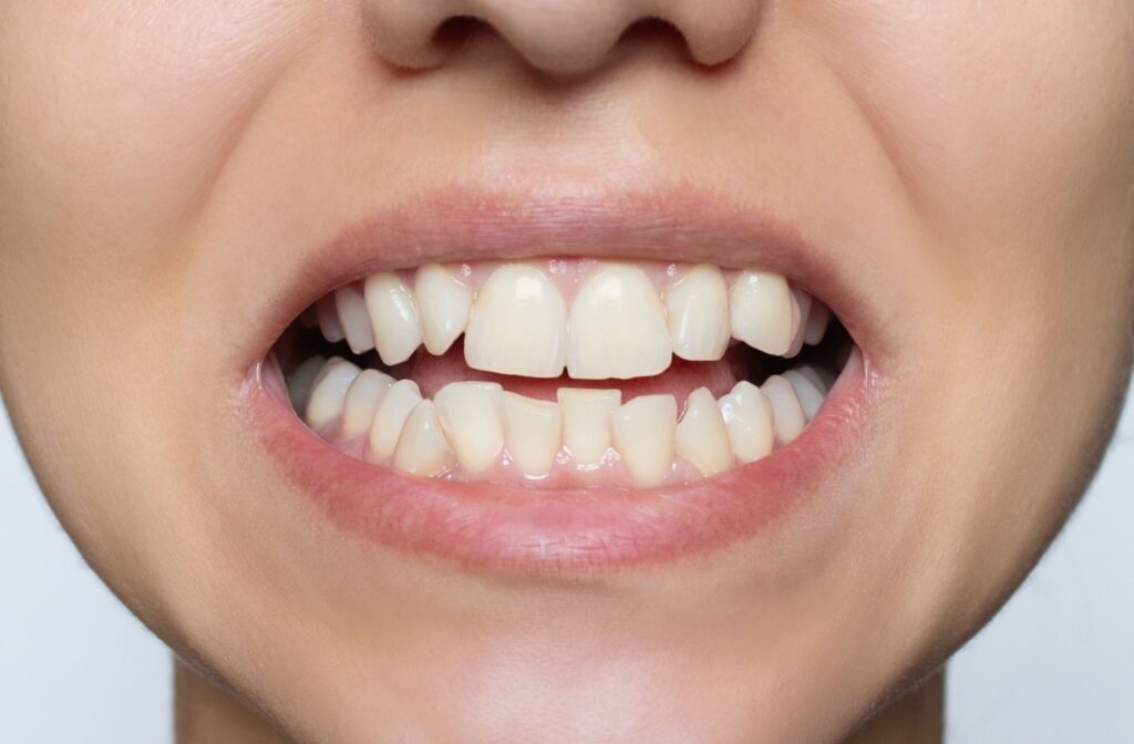 A close-up of a person's crooked smile and is considering treatment.