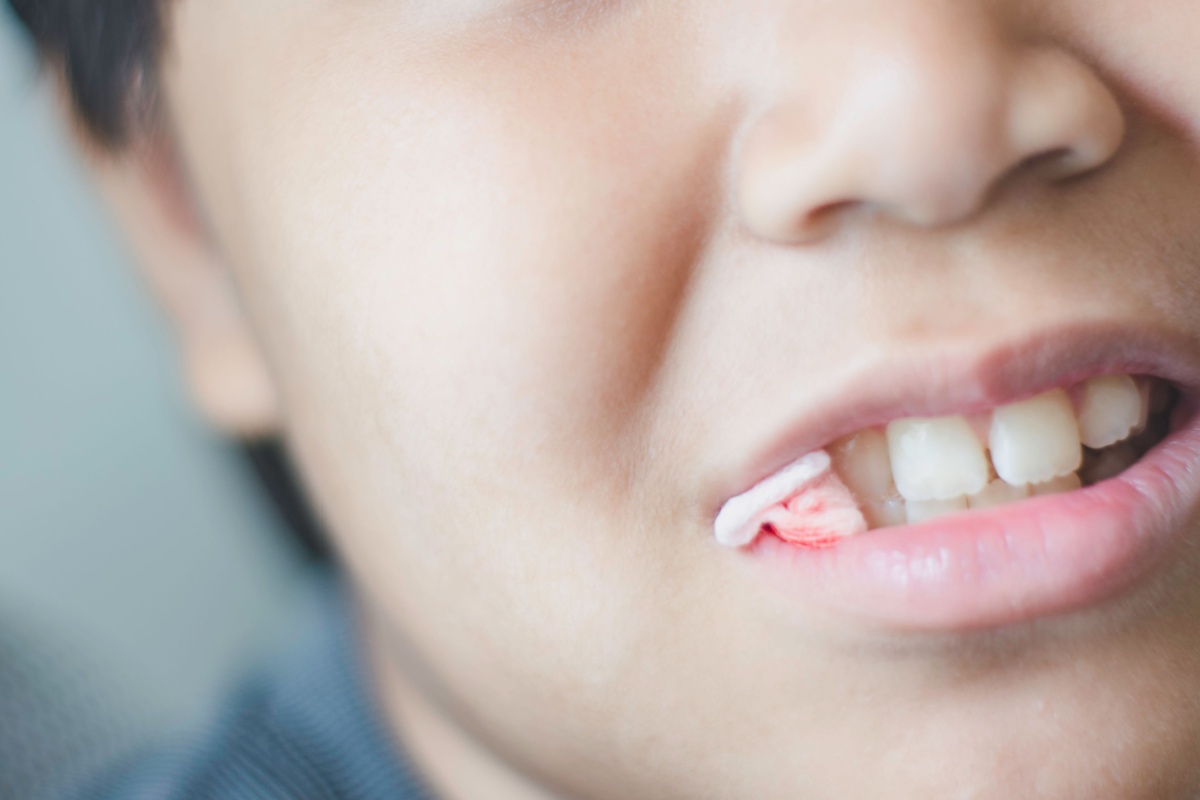 A close up of a child with gauze in their mouth after a tooth extraction