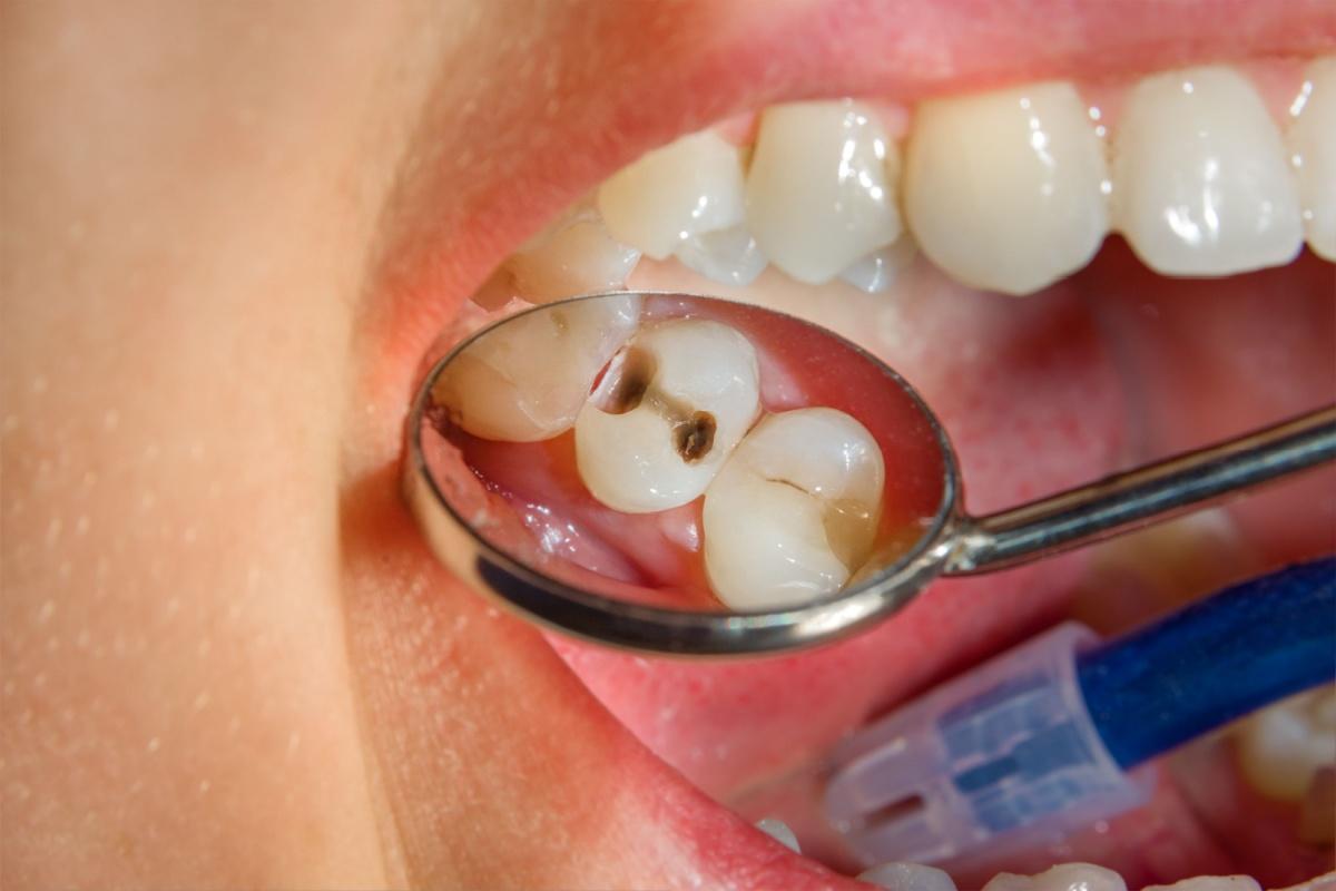 A dental mirror showing the under side of a person tooth that has a cavity on it