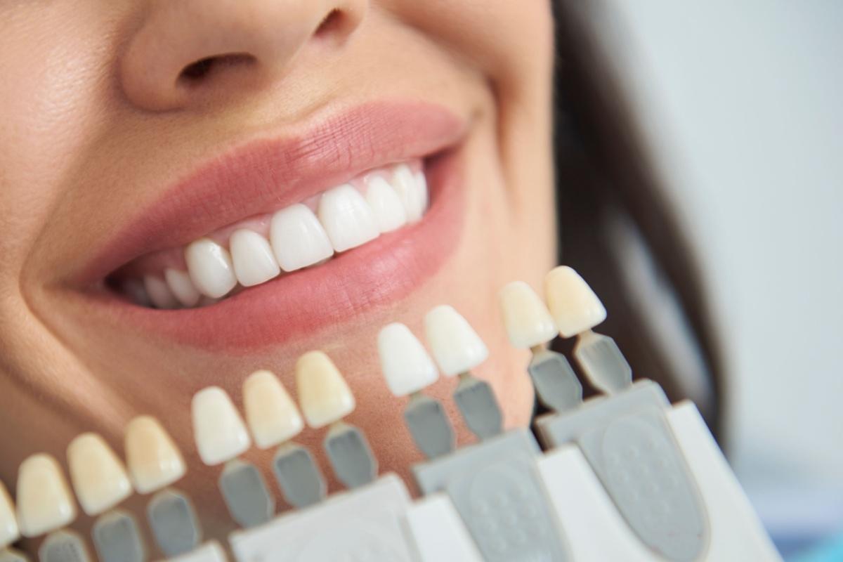 a close up of teeth getting fitting for different teeth whitening options